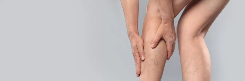 Solutions naturelles pour accompagner la rétention d’eau et favoriser une sensation de jambes légères