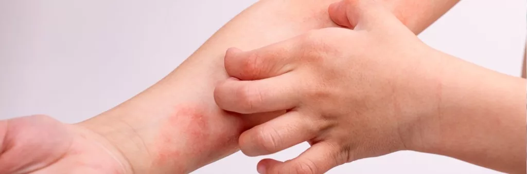 Solutions naturelles pour apaiser les peaux sujettes à la dermatite atopique et favoriser le confort cutané